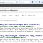 bell palsy 2